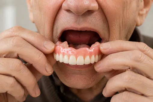 Man putting in a set of complete dentures at Edmonds Dental Studio in Edmonds Washington.