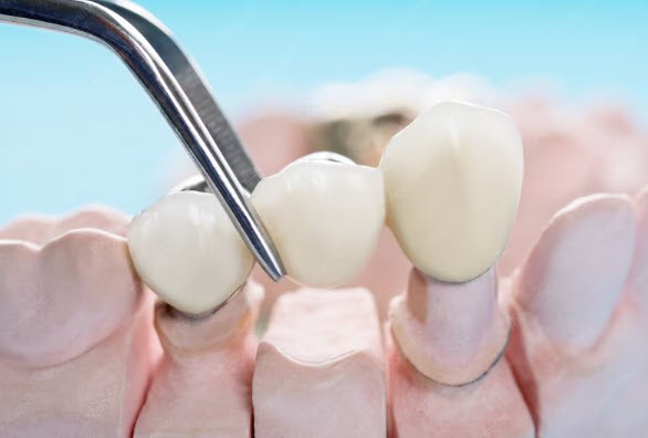 Rendering of jaw with dental bridge from Edmonds Dental Studio in Edmonds, WA