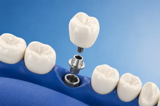 Illustration of a crown being placed on a dental implant at Edmonds Dental Studio in Edmonds Washington.